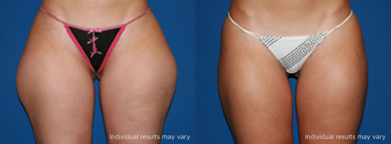 liposuction before and after