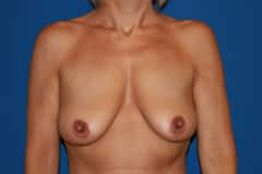 Breast Lift With Augmentation Patient 04 Before