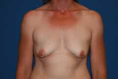 Breast Lift With Augmentation Patient 01 Before