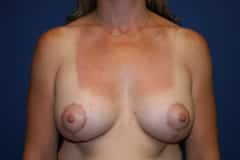 Breast Lift With Augmentation Patient 01 After