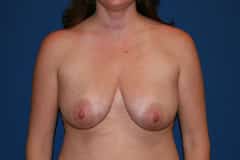 Breast Lift Patient 02 Before