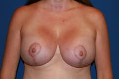 Breast Lift Patient 02 After