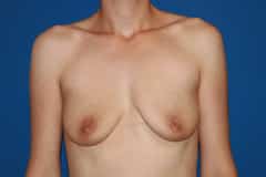 Breast Lift Patient 03 Before