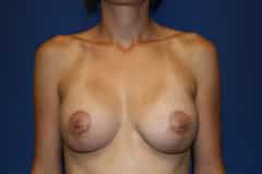 Breast Lift Patient 03 After