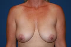 Breast Lift Patient 01 Before