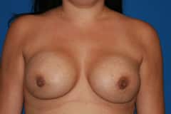 Breast Implant Revision 03 Before
