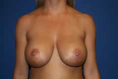 Breast Implant Revision 04 Before