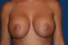 Breast implant revision surgery