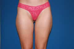 Thigh Lift Patient 03 Before