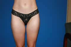 Thigh Lift Patient 03 After