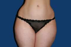 Thigh Lift Patient 01 Before