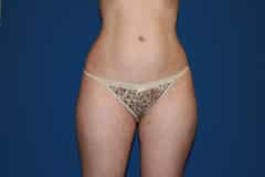 Thigh Lift Patient 01 After