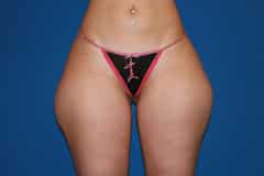 Thigh Lift Patient 02 Before