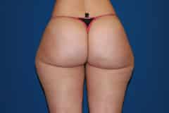 Thigh Lift Patient 04 Before