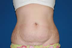 Tummy Tuck Patient 02 Before