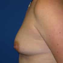 before Breast Augmentation