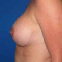 after Breast Augmentation