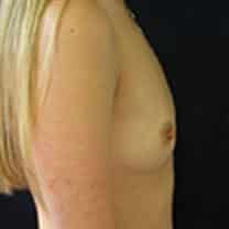 before Breast Augmentation