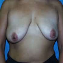 before Breast Augmentation