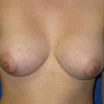 Breast Augmentation