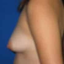 before Breast Augmentation