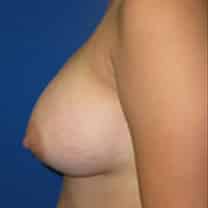 after Breast Augmentation