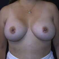 after Breast Augmentation