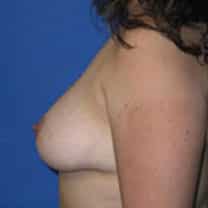 befpore Breast Augmentation