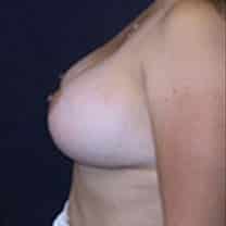 after Breast Augmentation