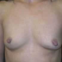 before Breast Augmentation