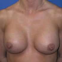 after Breast Augmentation