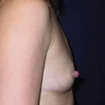 before Breast Augmentation