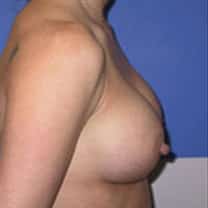 after Breast Augmentation