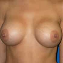 after Breast Augmentation