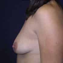 before Breast Augmentation