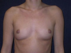 before Breast Augmentation