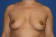 before Breast Augmentation