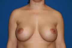 after Breast Augmentation