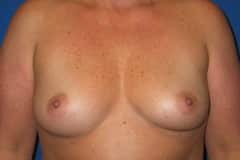 before Breast Augmentation