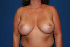 after Breast Augmentation