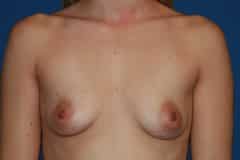 before Breast Augmentation