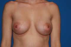 Breast Augmentation