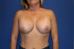 after Breast Augmentation