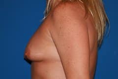 Breast Augmentation