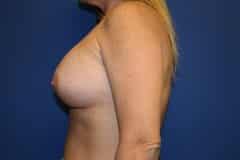 after Breast Augmentation