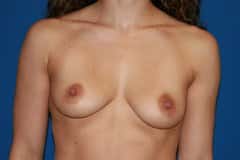 beofre Breast Augmentation