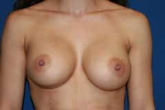 after Breast Augmentation