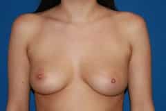 before Breast Augmentation