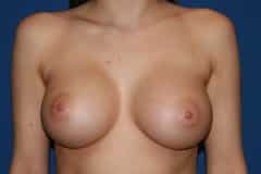 after Breast Augmentation