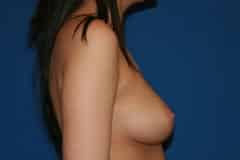 before Breast Augmentation